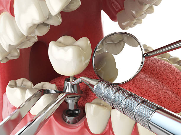 Best Emergency Tooth Extraction in Hallstead, PA